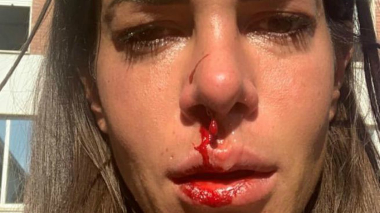 Temptation Island: ex protagonista aggredita dal padre, le Foto con il volto insanguinato