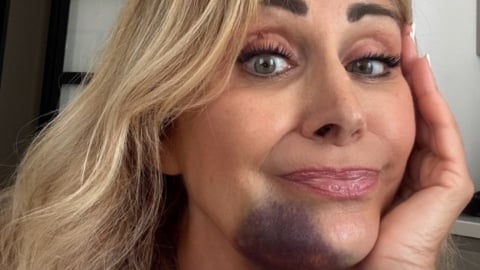 Marina Di Guardo, la mamma di Chiara Ferragni mostra un vistoso ematoma sul volto: cosa è successo