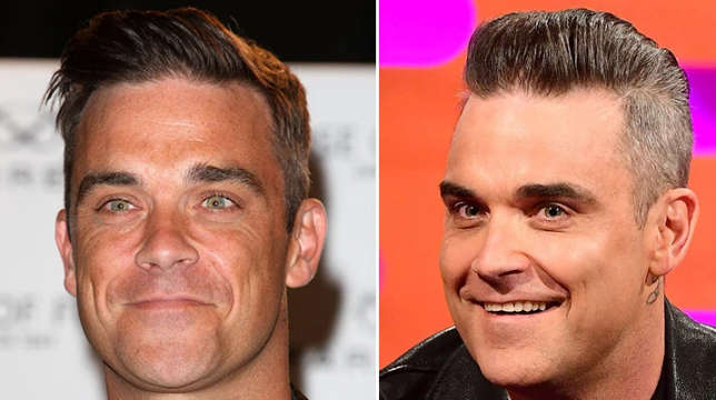 Robbie Williams confessa l'abuso del botox