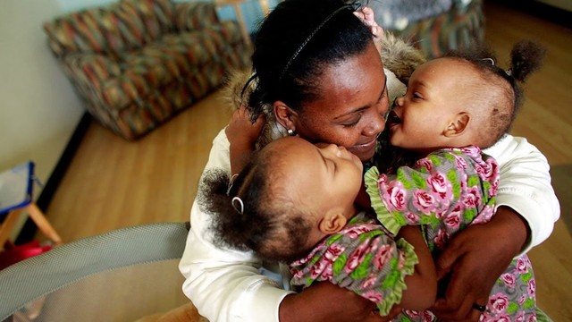 Gemelle siamesi: prima e dopo