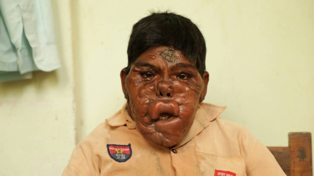 Il ragazzo ricoperto di bolle
